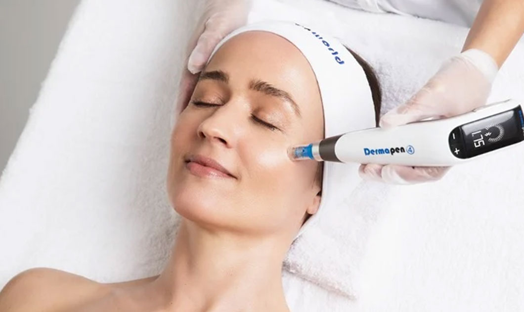 microneedling rf