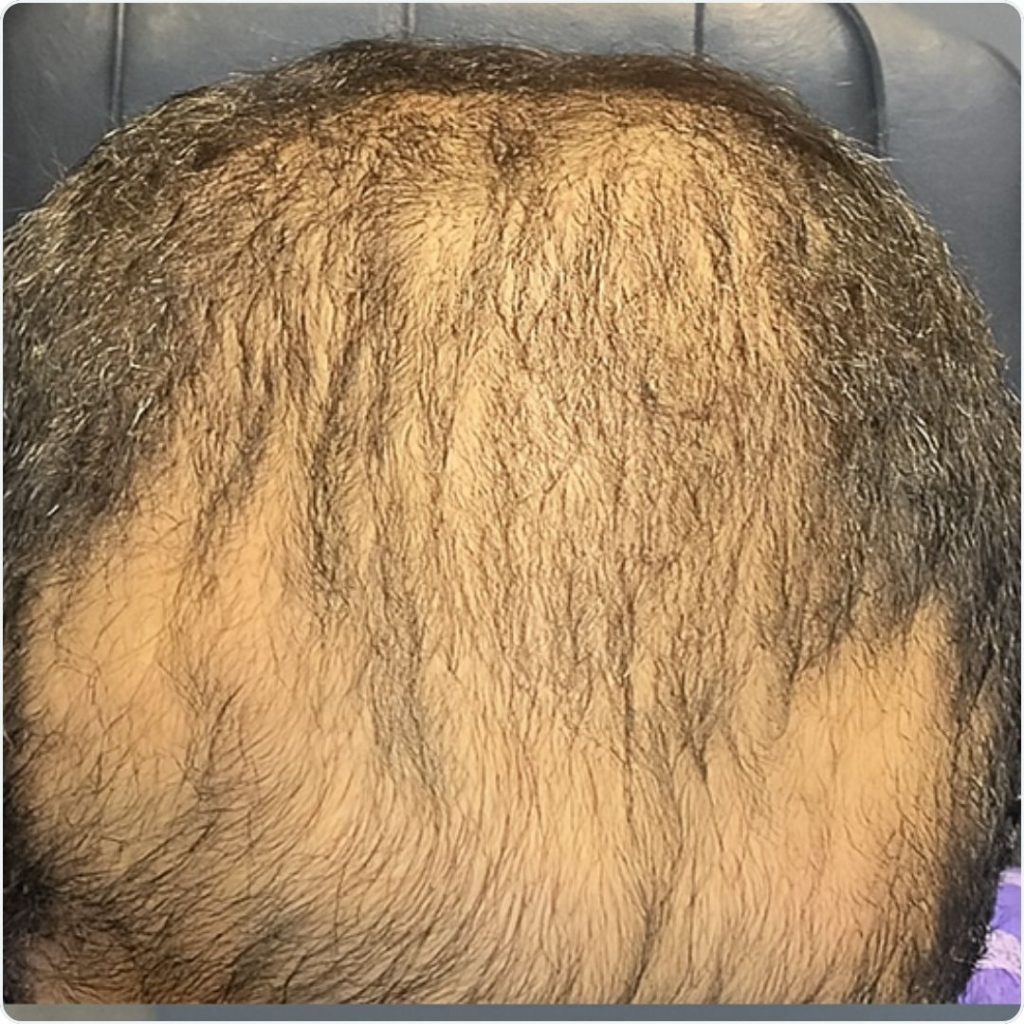 Before Hair PRP Treatment