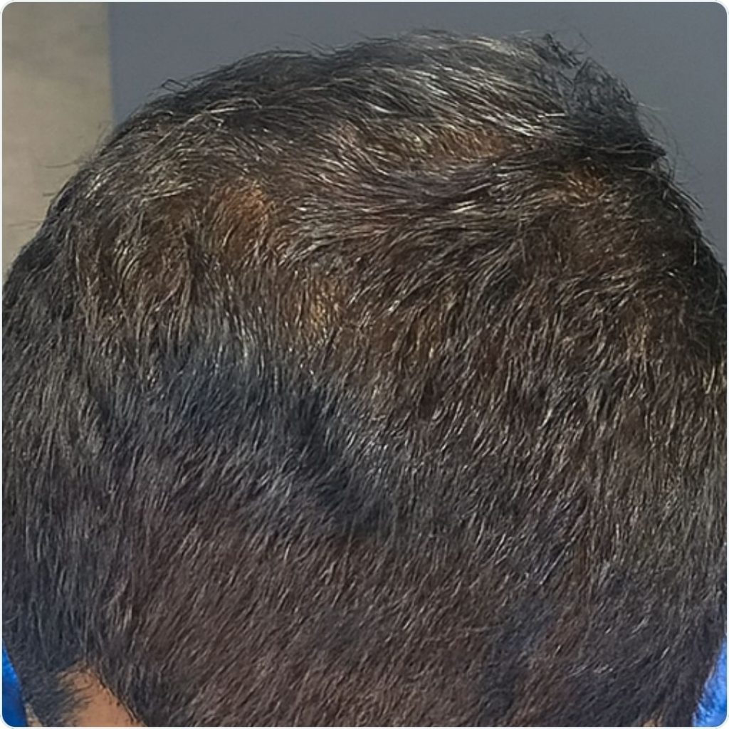After Hair PRP Treatment