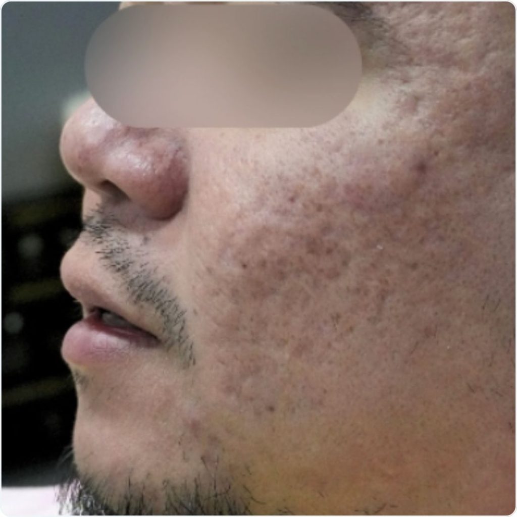 Fractional Laser in Doha Before