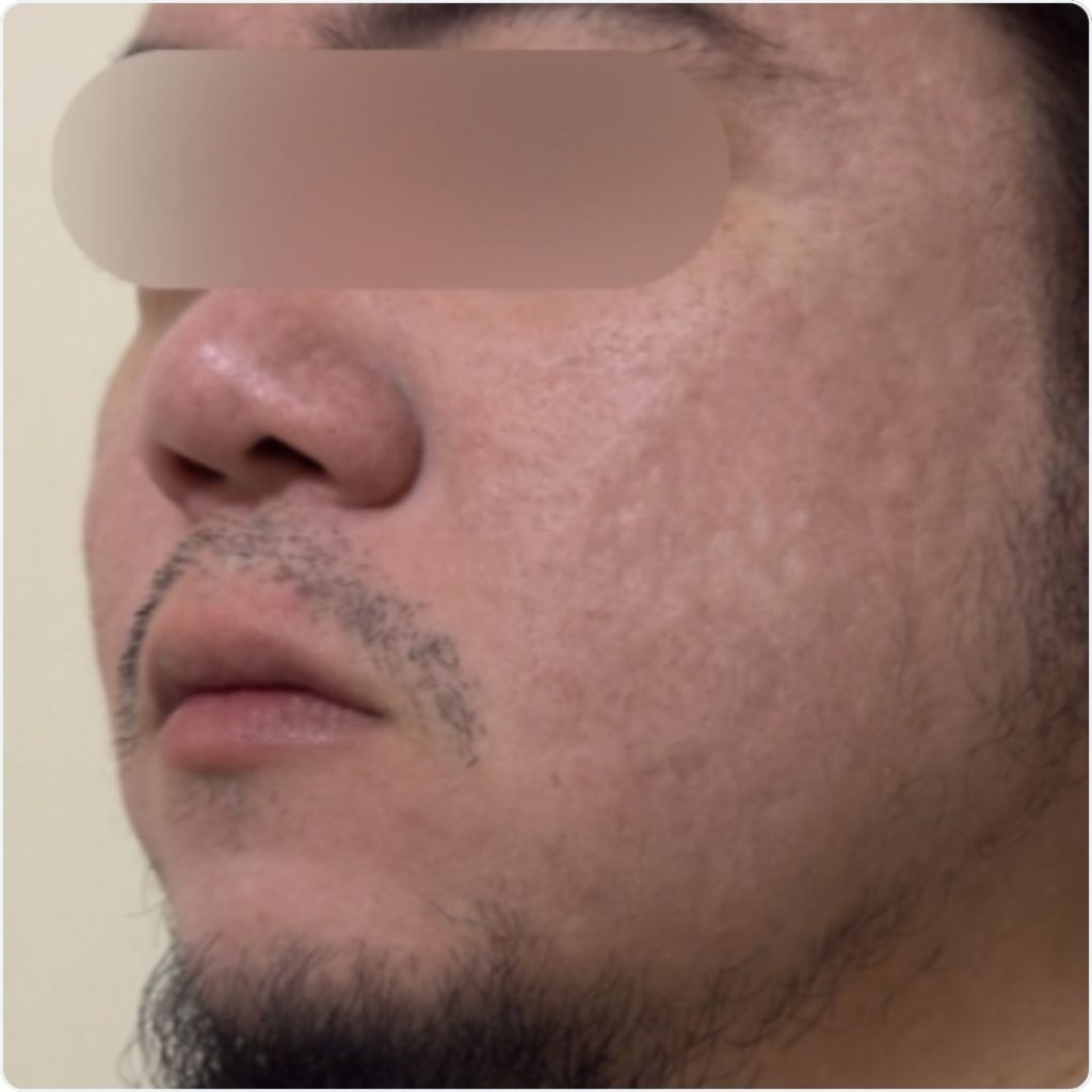 Fractional Laser in Doha After