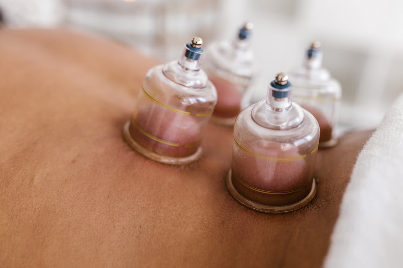 Cupping Therapy in Doha