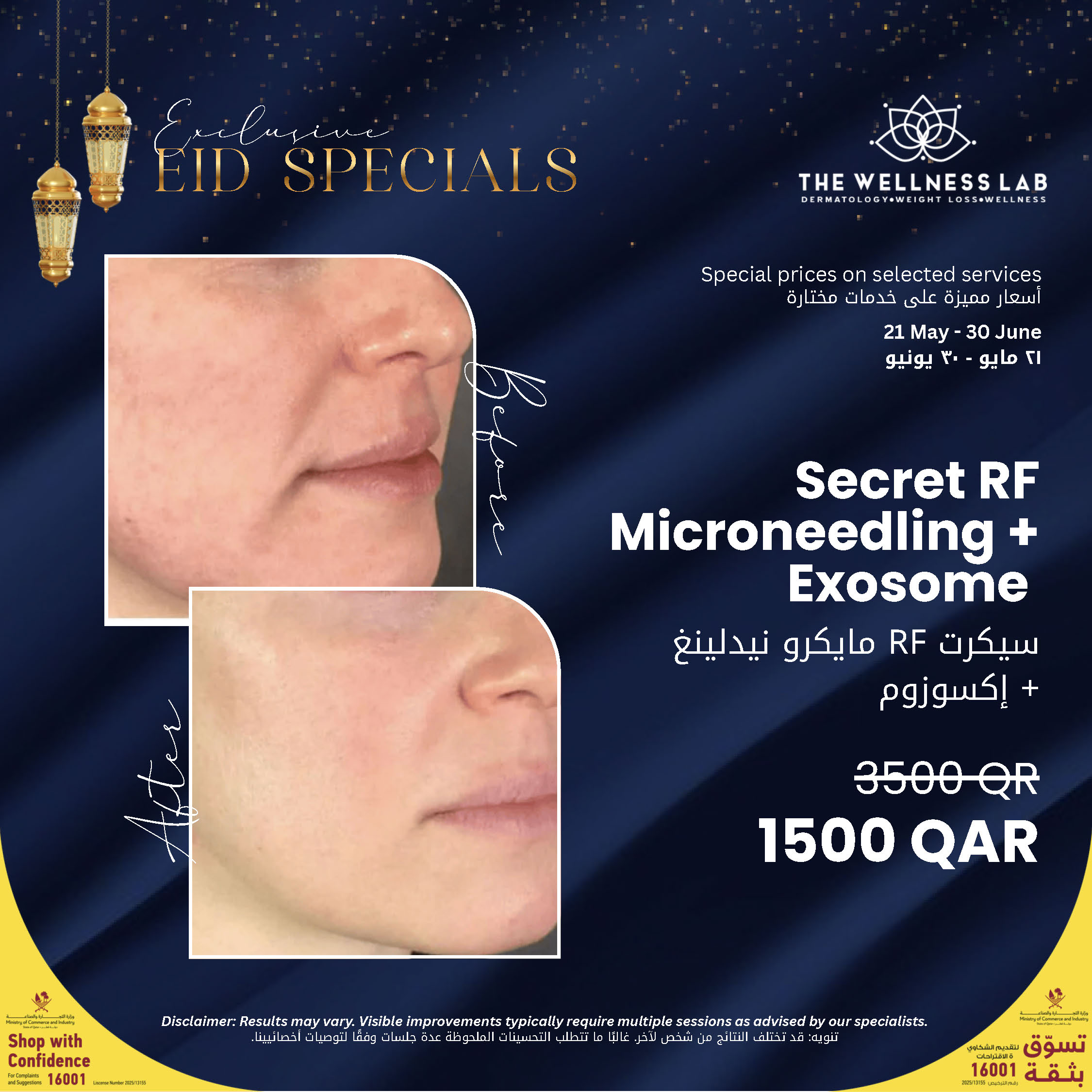 Secret RF Microneedling + Exosome