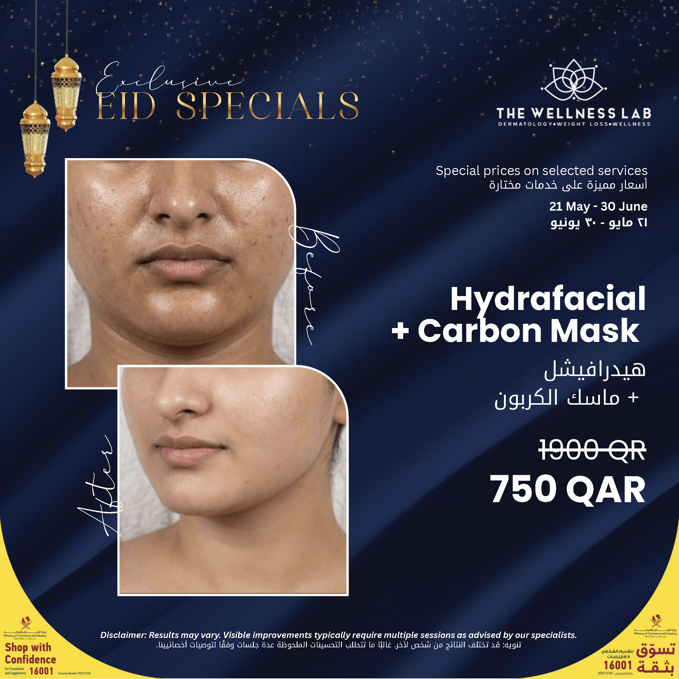 Hydrafacial + Carbon Mask