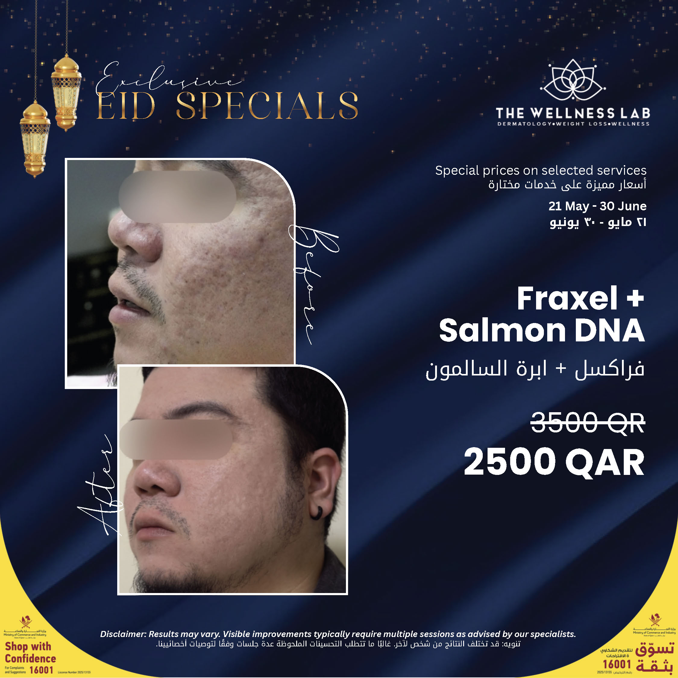 Fraxel + Salmon DNA